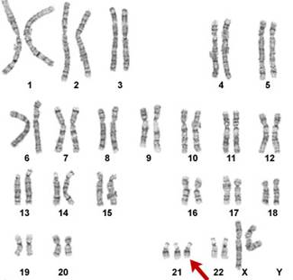 Kariotip osobe koja ima Downov sindrom