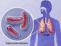 Mycobacterium tuberculosis